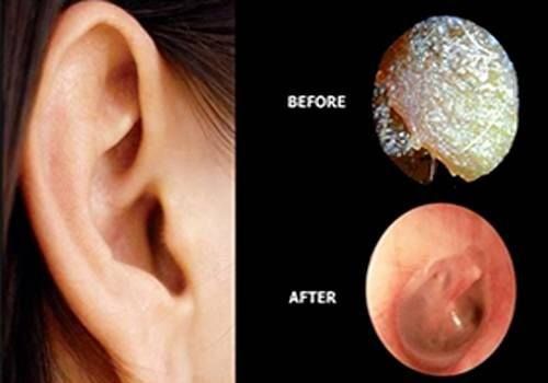 Ear Wax Removal 