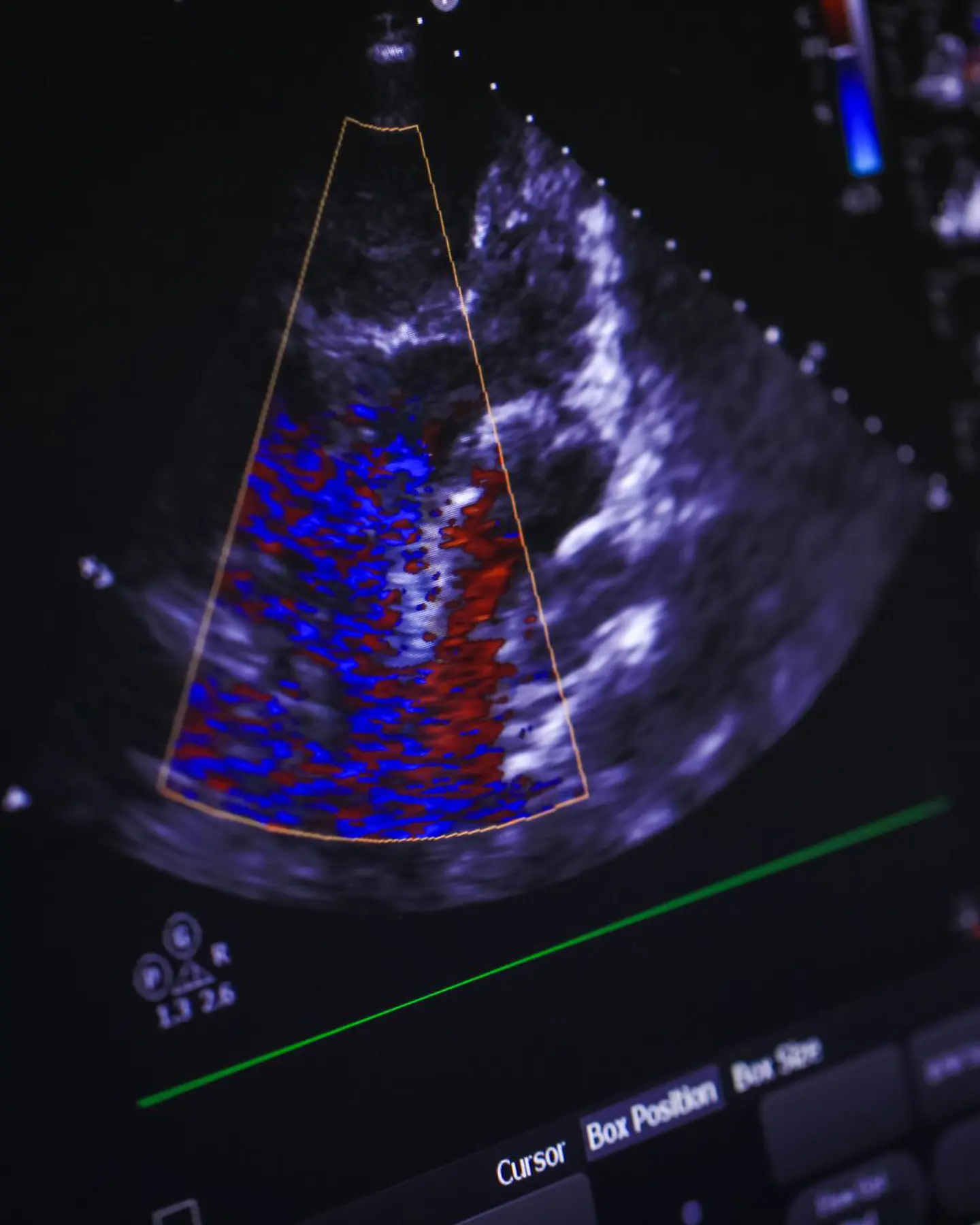 Echocardiogram Soundwaves