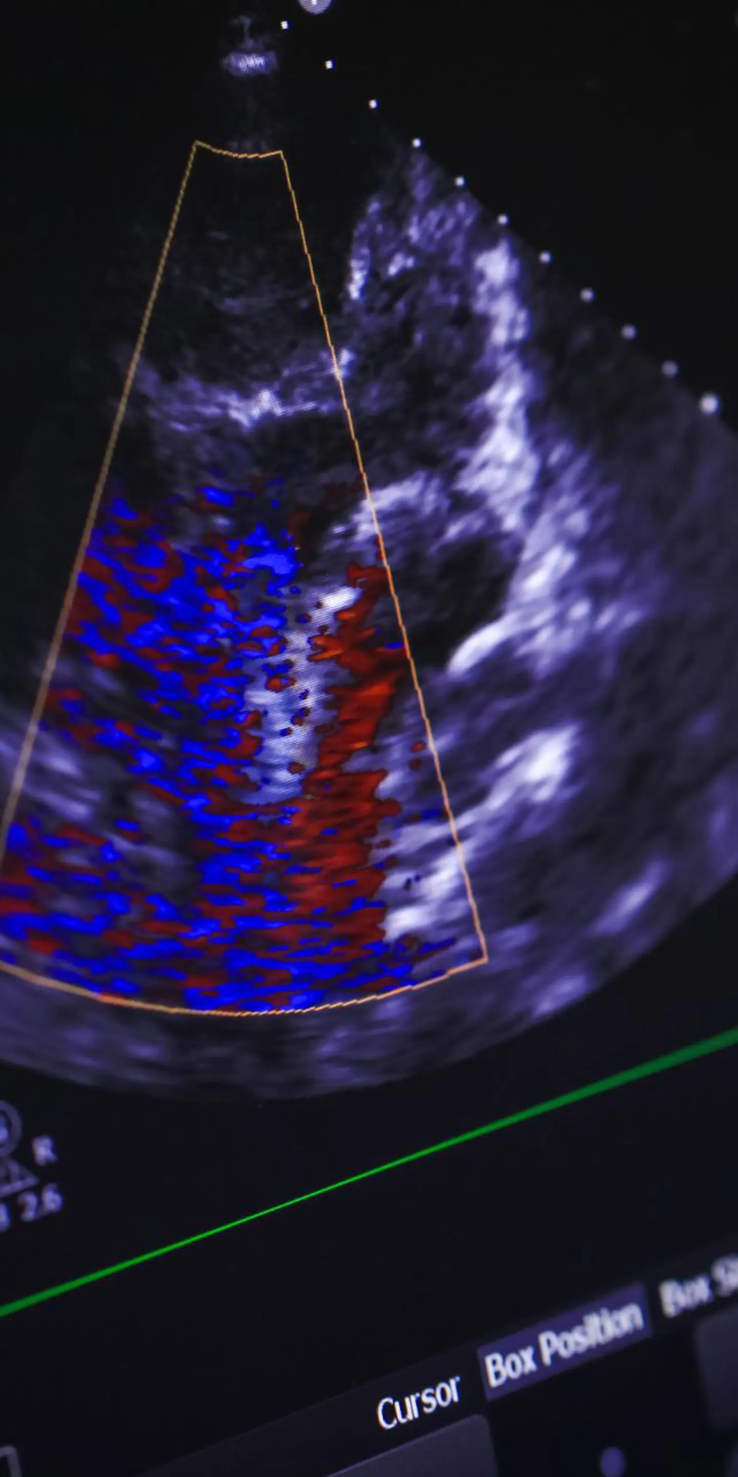 Echocardiogram Soundwaves