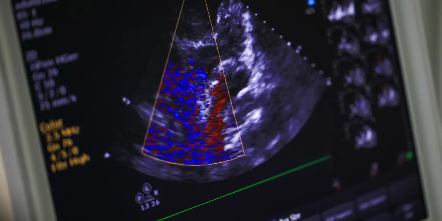 Echocardiogram Soundwaves