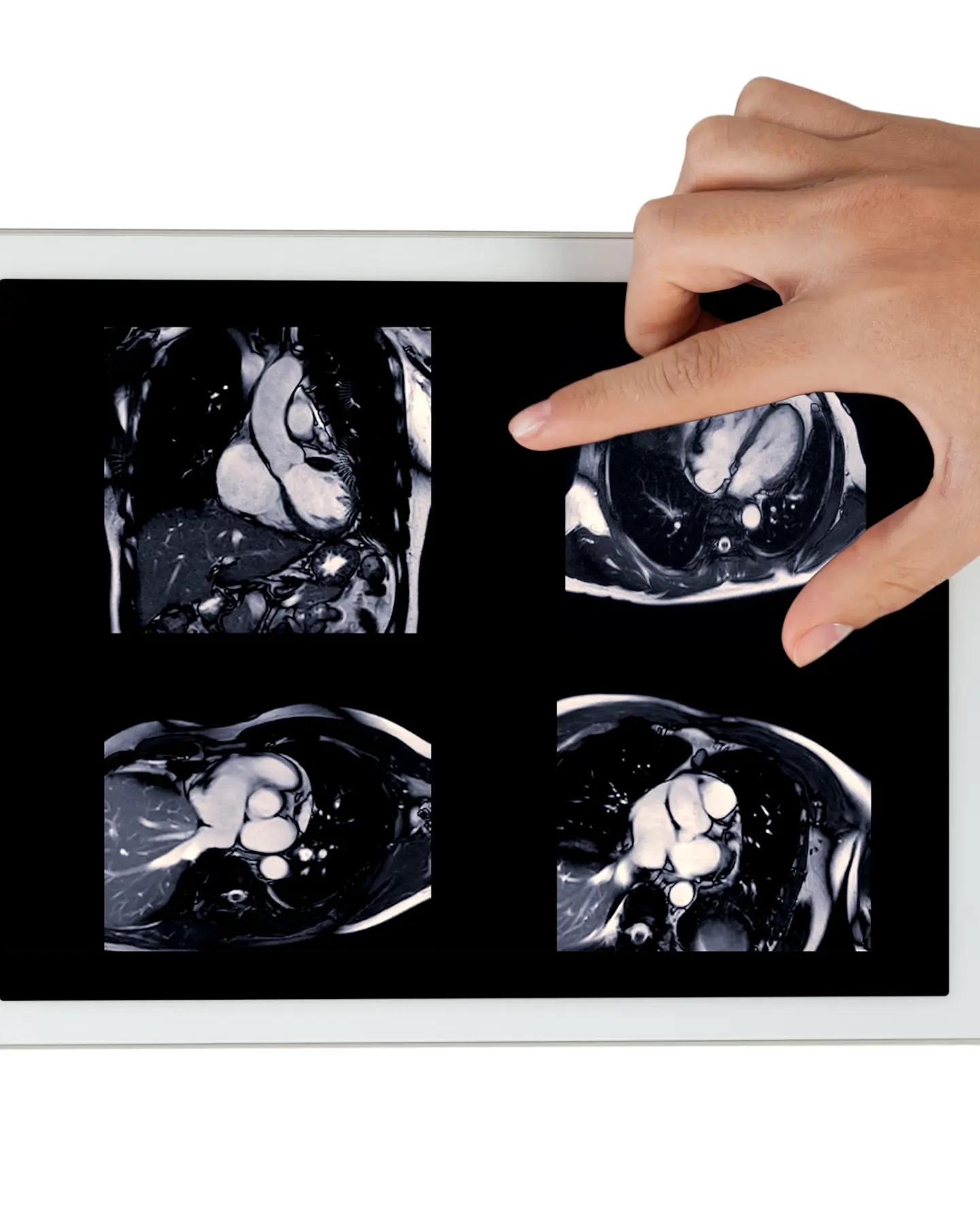 Cardiac MRI Scan