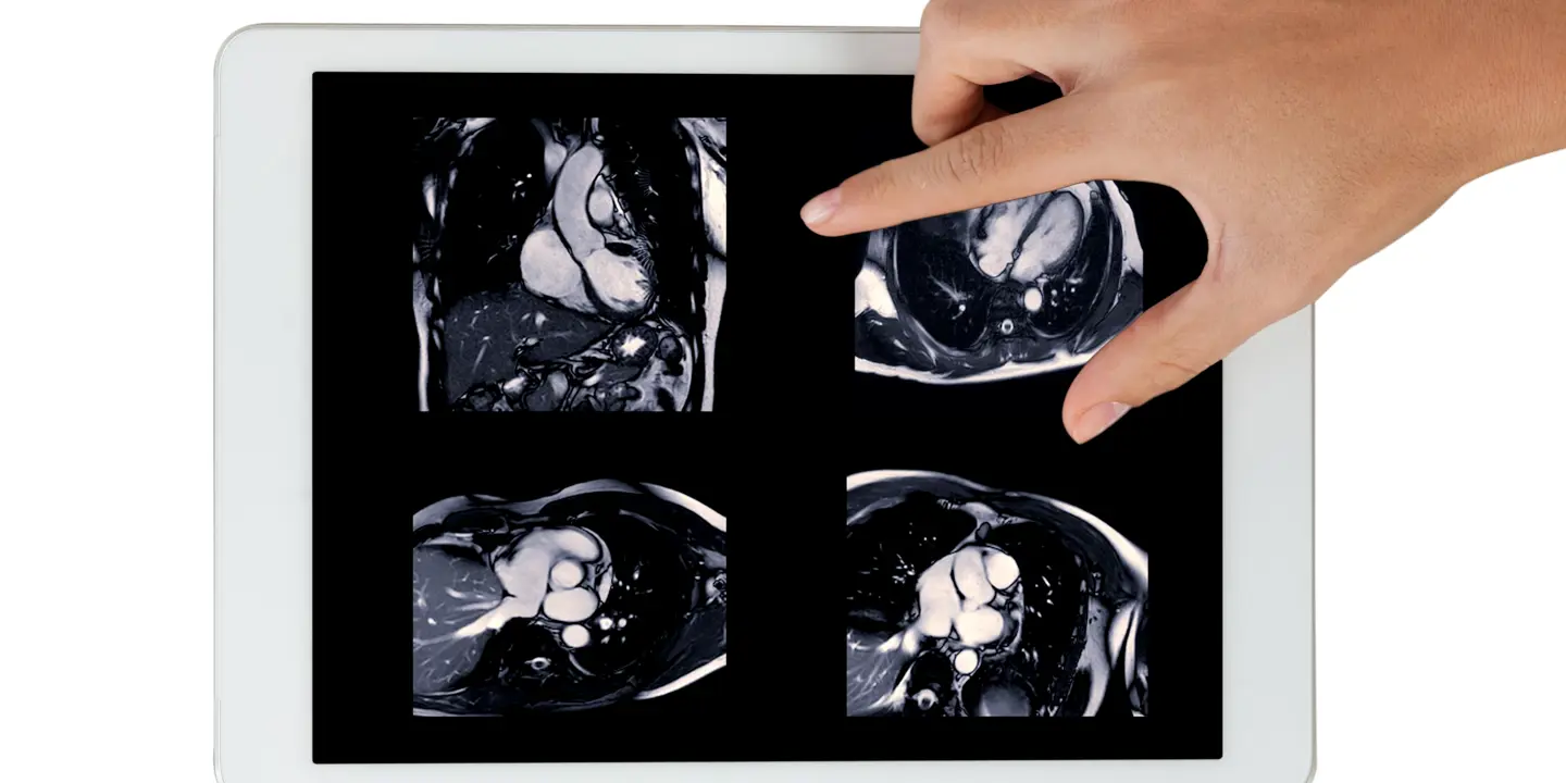 Cardiac MRI Scan