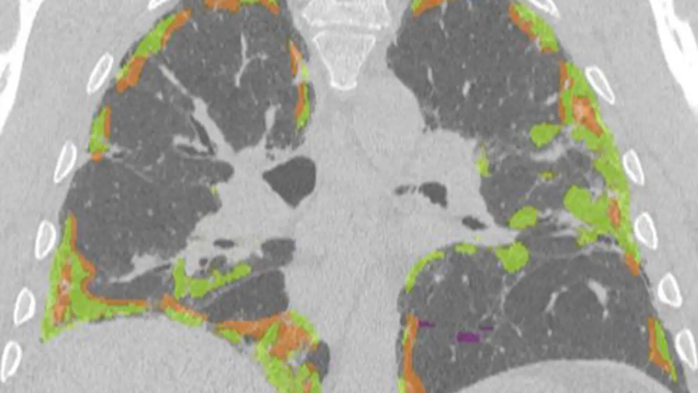 Lung Image