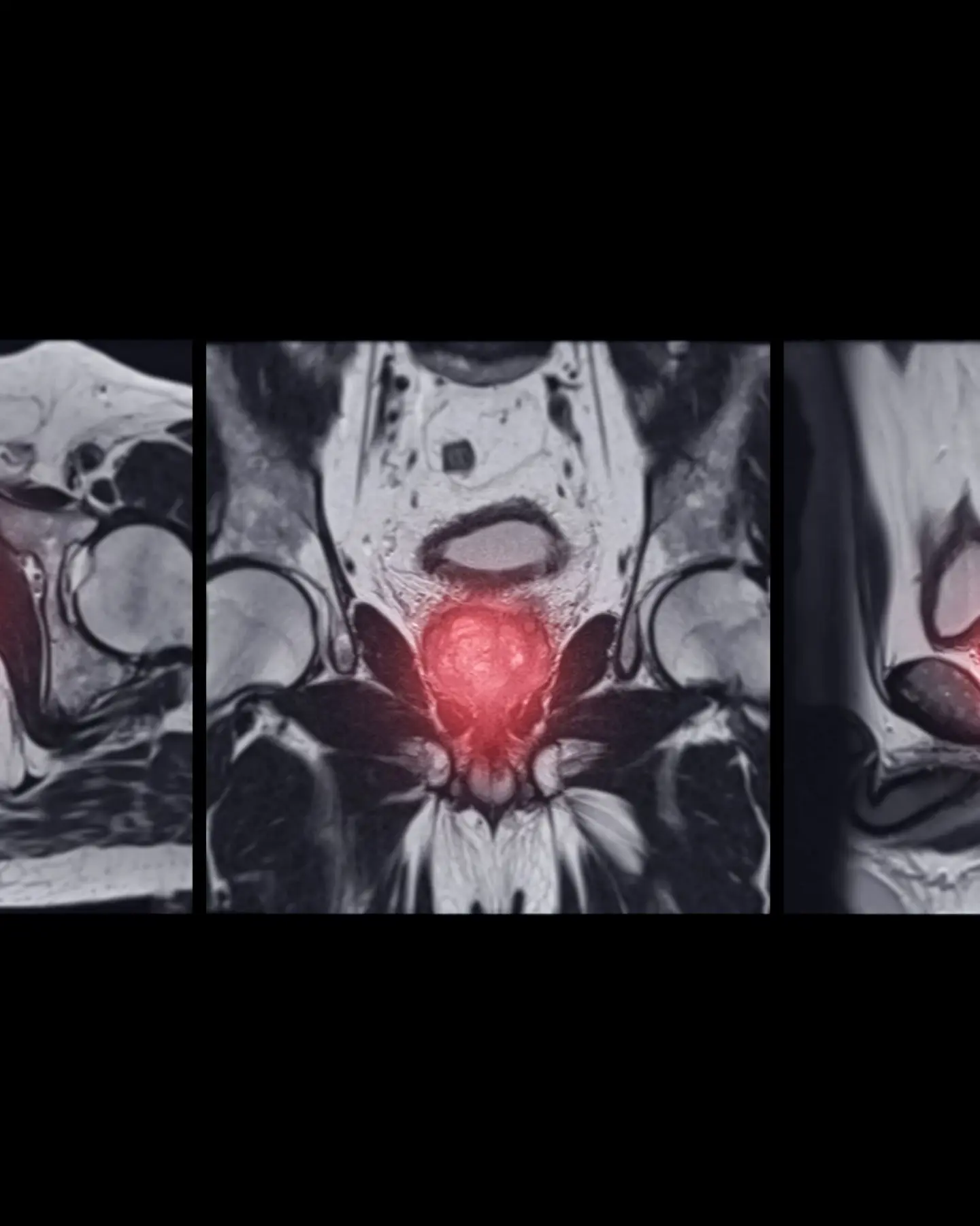 MRI Prostate Gland Axial Coronal And Agittal T2W