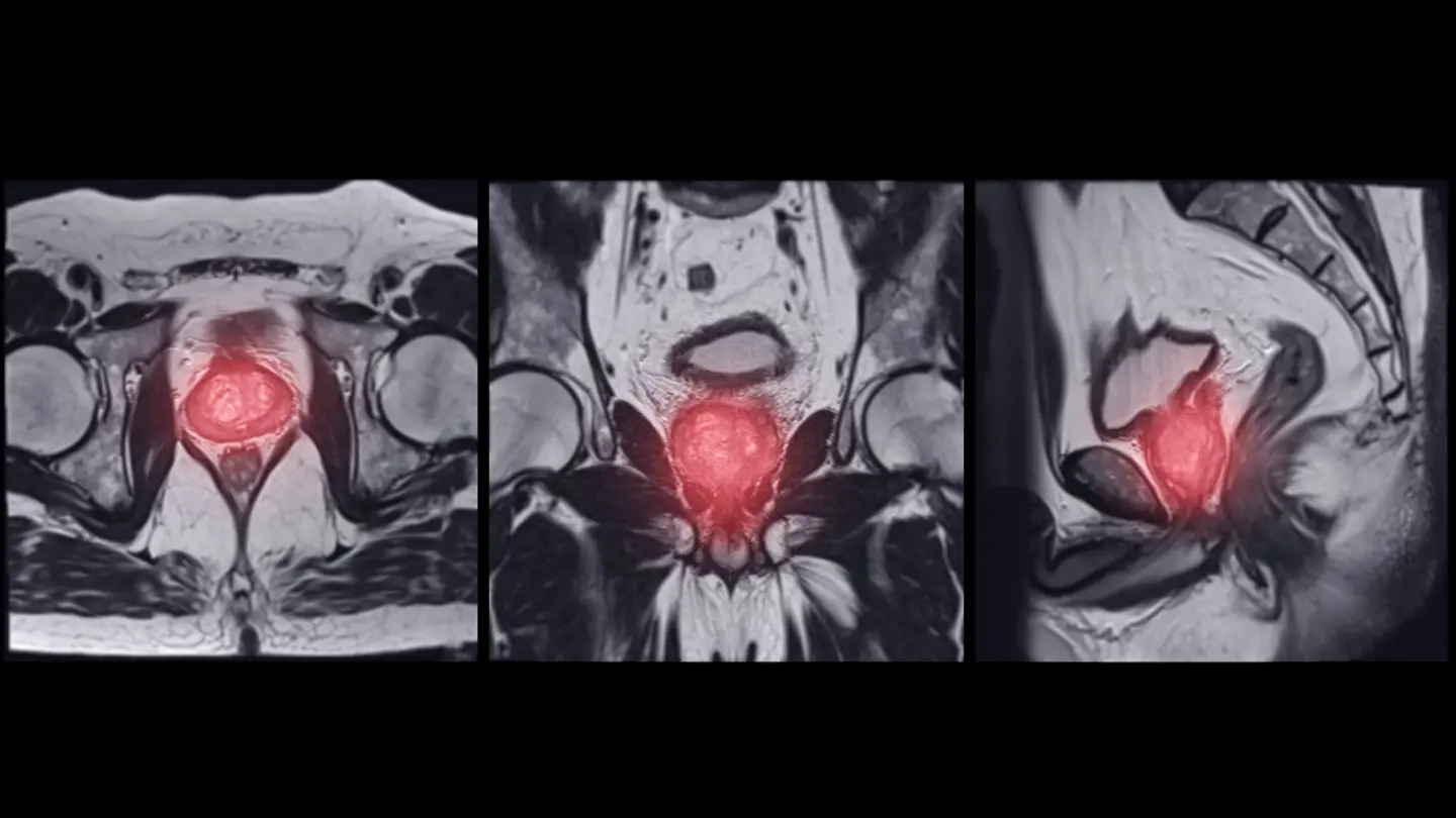 MRI Prostate Gland Axial Coronal And Agittal T2W